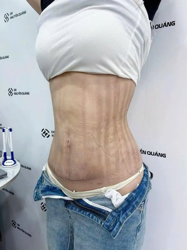 Sau 1 tháng hút mỡ tạo hình bụng