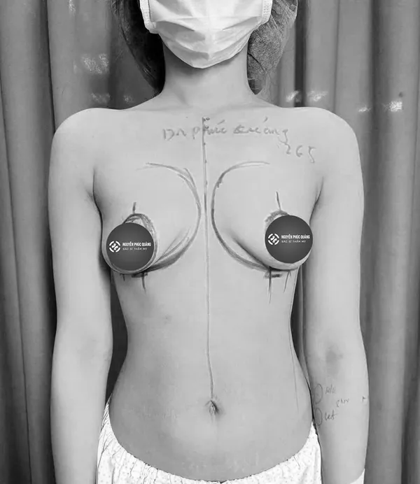 Trước nâng ngực sa trễ