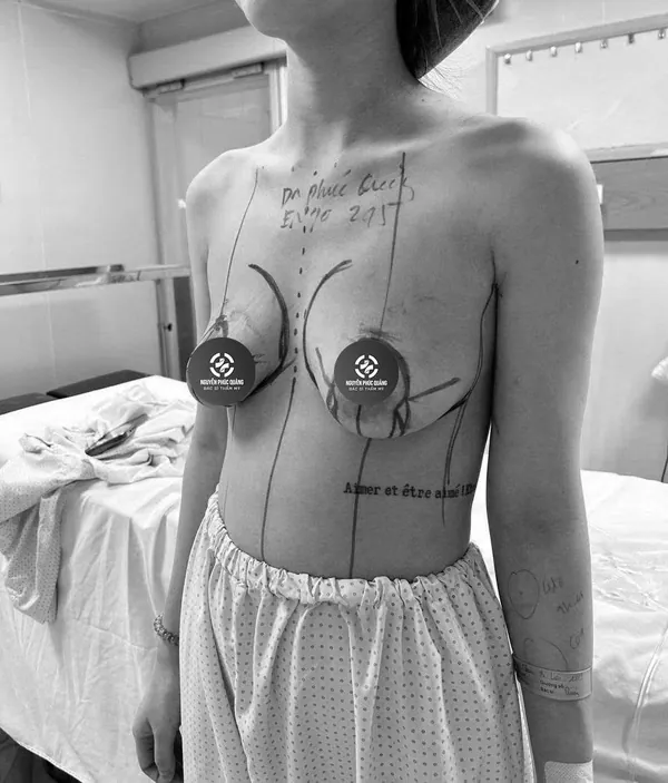 Trước – vòng 1 sa trễ