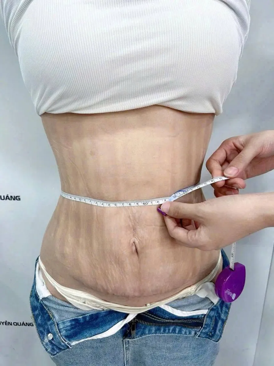 Hút mỡ tạo hình vòng eo